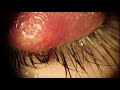 Huge external hordeolum stye  lanced and milked