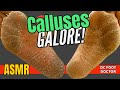 Calluses Galore! Affect of Chemotherapy on Skin of the Feet and Amazing Transformation (ASMR)