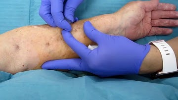 VideoEN 3.3. Buttonhole needling technique