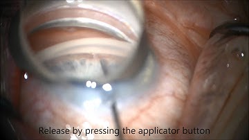 How to insert iStent glaucoma implant. Chris Teng, MD