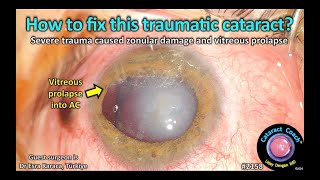 CataractCoach™ 2158: How to fix this traumatic cataract with vitreous prolapse?