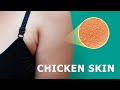 How to Heal Keratosis Pilaris (Chicken Skin) Naturally