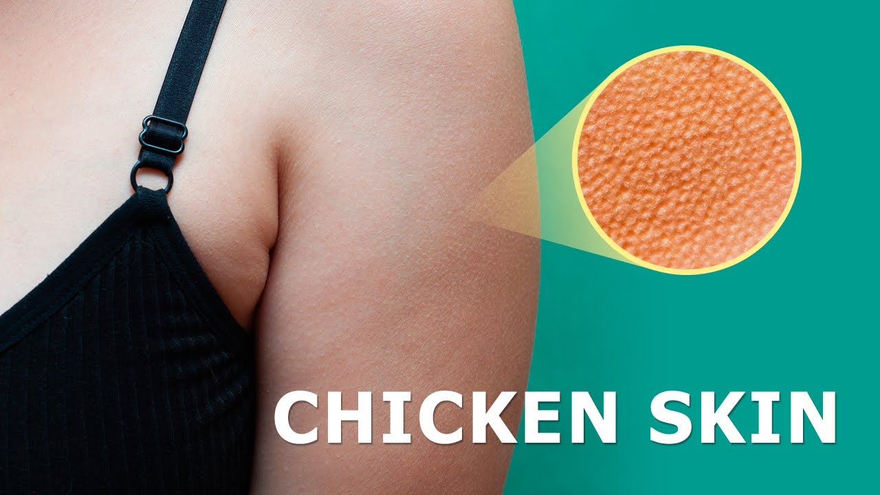 How to Heal Keratosis Pilaris (Chicken Skin) Naturally