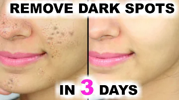 How can I remove dark spots in 2 days at home?