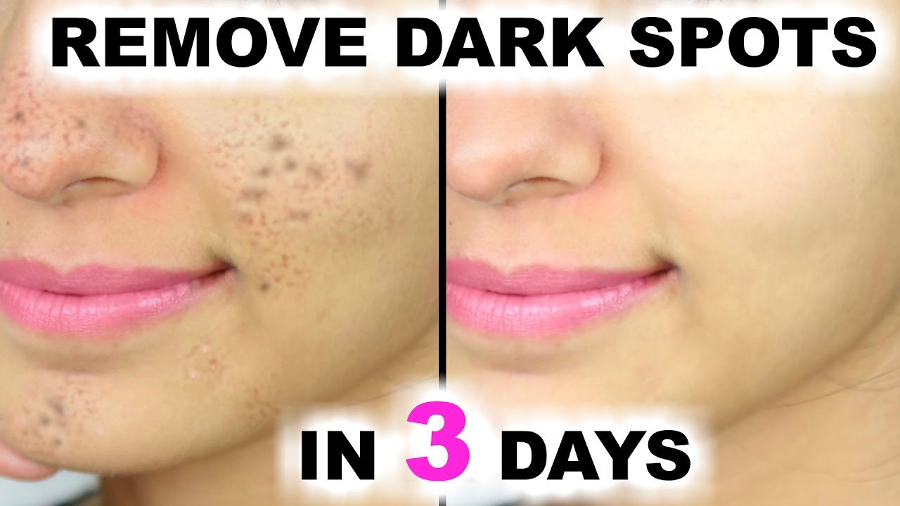 In 3 DAYS - Remove DARK SPOTS, BLACK SPOTS &amp; ACNE SCARS ...