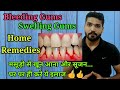 मसूड़े से खून आने पर घरेलू इलाज |Bleeding gums treatment at home| Home remedies for bleeding gum
