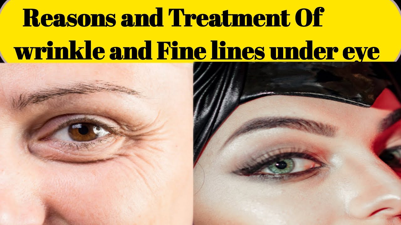 Reasons & Treatment Of wrinkle and Fine lines under the eyes,Dr.Sarfaraz khan V&S YouTube