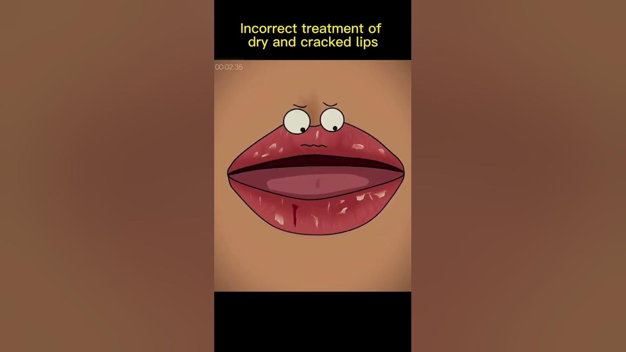 Dry And Cracked lips