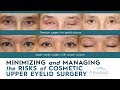 Risks of Cosmetic Upper Eyelid Surgery, and How they are Minimized and Managed