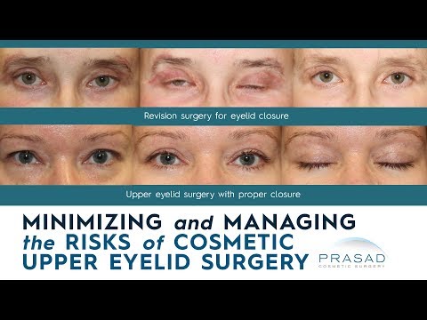 Risks of Cosmetic Upper Eyelid Surgery, and How they are Minimized and Managed