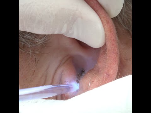 Cerumen Impaction Pepper Style!  Monster Wax Removal!