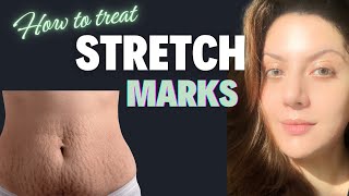 How to Remove Stretch Marks after Pregnancy I How to Remove Stretch Marks  at Home