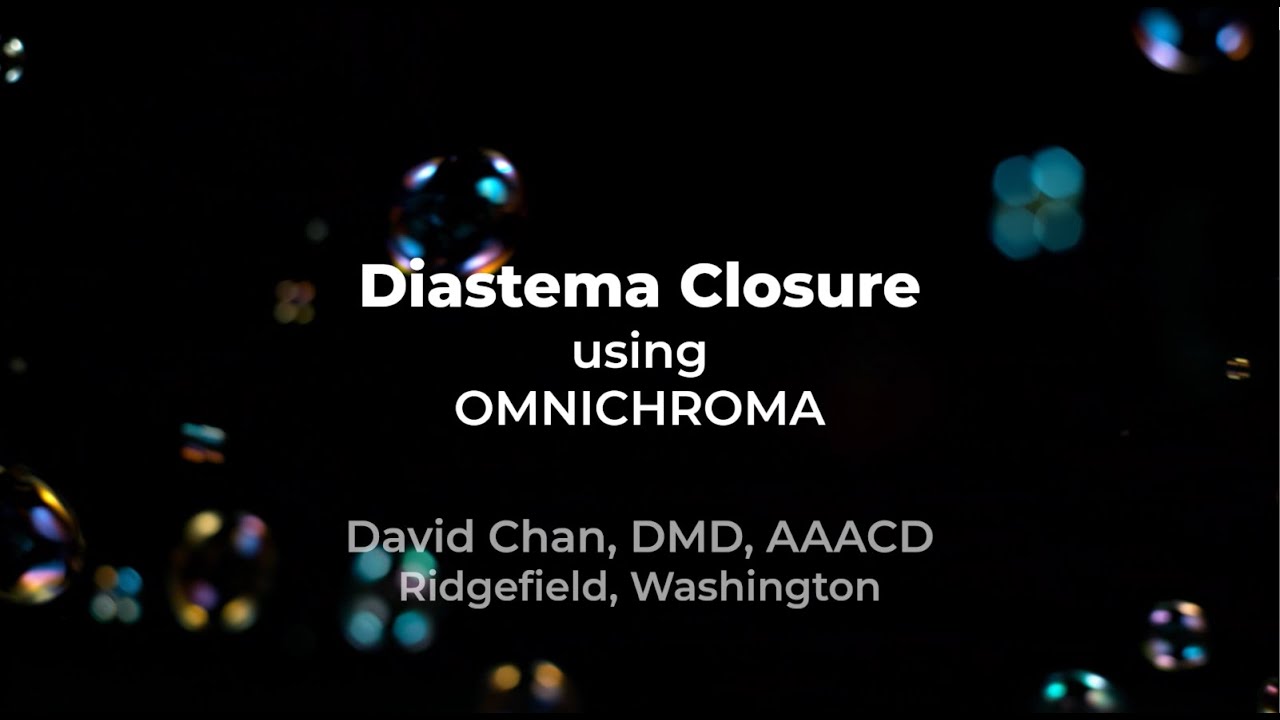 Diastema Closure using OMNICHROMA - YouTube