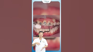 Quy Trình Niềng Răng Khấp Khểnh Diễn Ra Như Nào ? | Bác Sĩ Yên