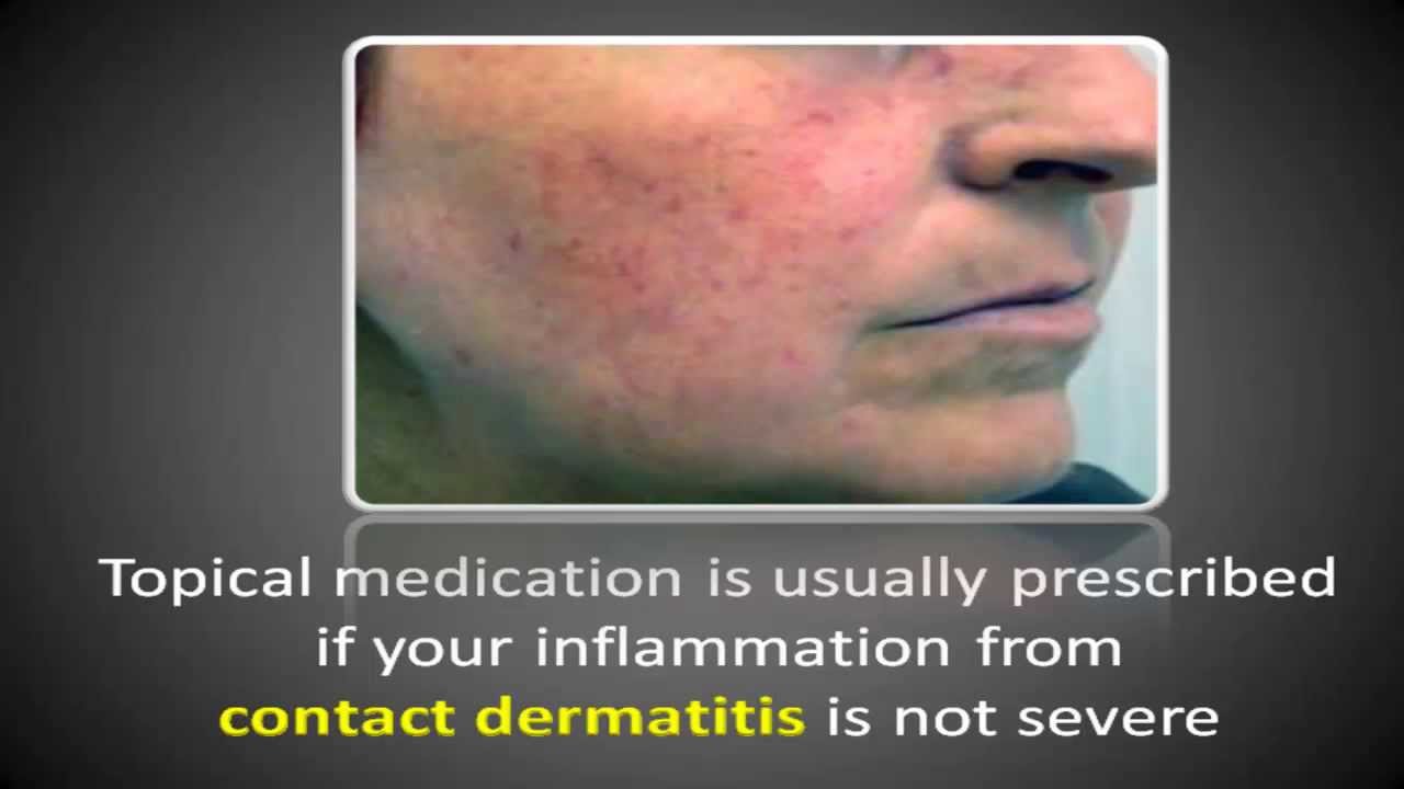 Contact Dermatitis Treatment and its Side Effects - YouTube