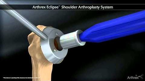 Arthrex   Arthrex ECLIPSE™ Shoulder Arthroplasty System