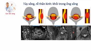 TRIỆU CHỨNG HỌC CƠ BẢN TRÊN HÌNH CHỤP MRI CỘT SỐNG | TS. BS. Phạm Mạnh Cường