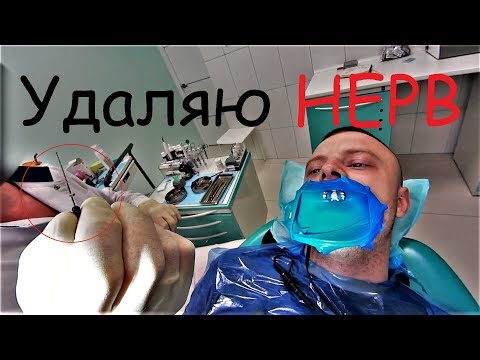 Удаляю НЕРВ!