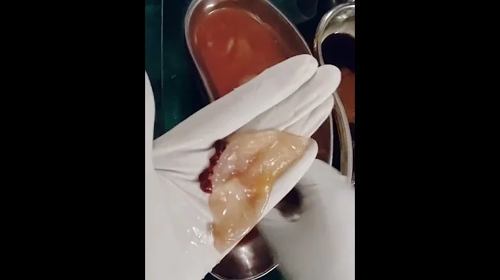 hydatid cyst - DayDayNews