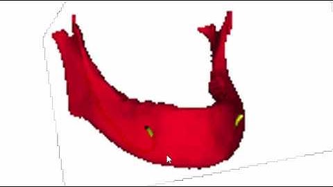3D Conversion Dicom to stl