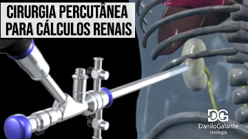 Quando um cálculo renal precisa de cirurgia?