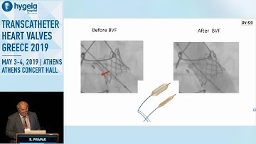 S. Prapas | The selection of SAVR devices in the TAVR era