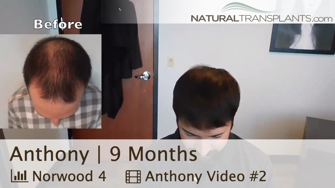 fue hair transplant month by month Hair Transplantation Before and After | Hair Transplantation Results (Anthony)