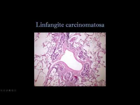 Linfangite carcinomatosa