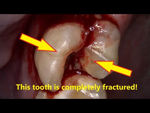 I extract a tooth that was split in half! - YouTube