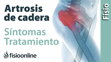 ¿Cuáles son los síntomas de la artritis grave de cadera?