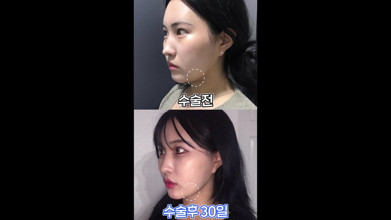 [艾塔整形外科] 雙下巴怎麼瘦？✨進行了狐狸輪廓術&線雕拉提。#shorts