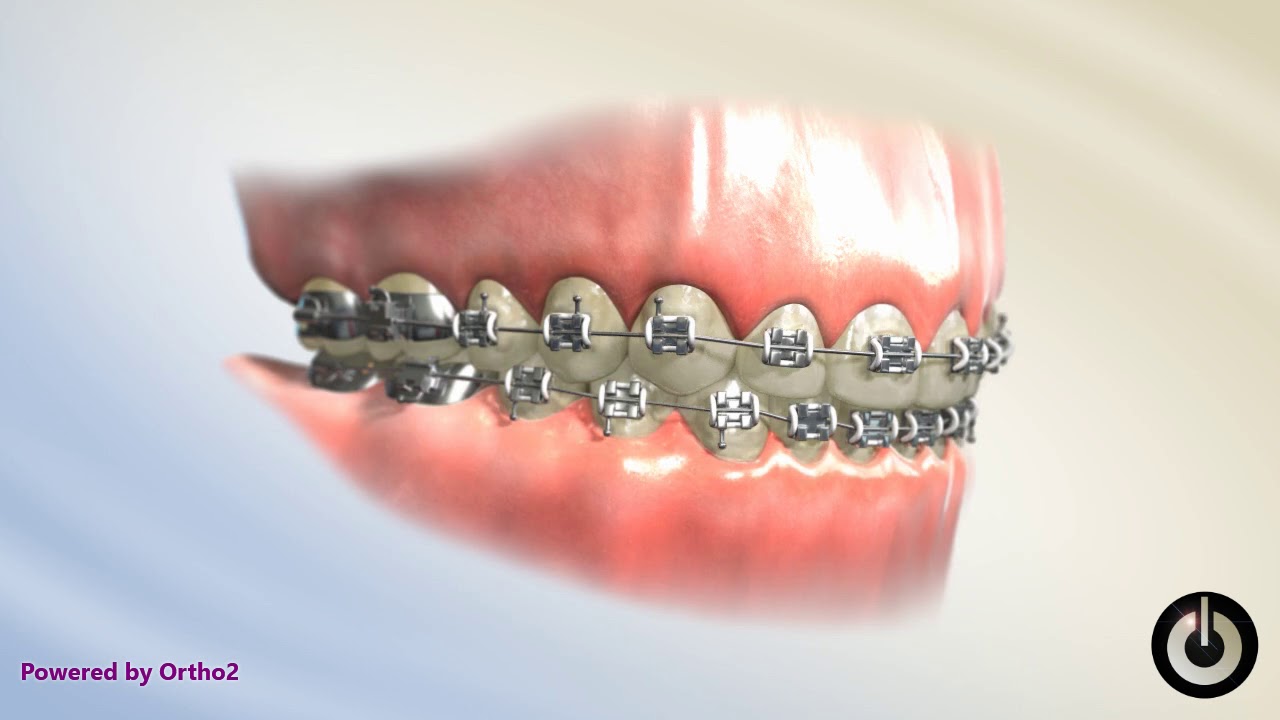 Decalcification Dental Braces Temecula Valley, CA YouTube