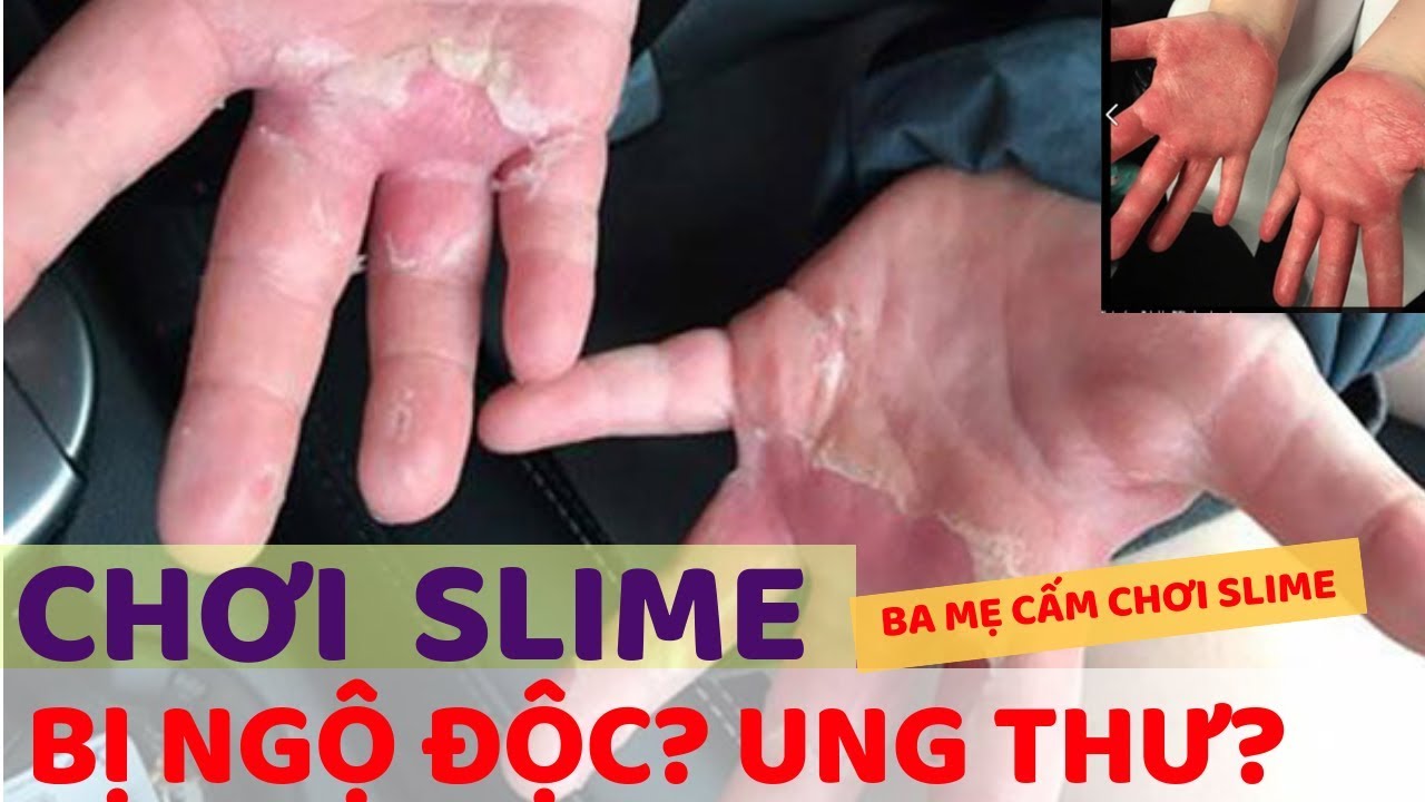 Ung Thư Vì Chơi Slime? Ngộ Độc Borax, Hàn The? Ba Mẹ Cấm Chơi Slime? -  Youtube