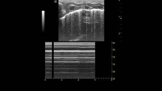 Pediatrics Lung POCUS