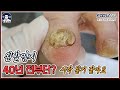 40년 된 무좀발톱, 갈수록 두꺼워져서 이제는 아프기까지. 딸이 모시고 왔어요 왼발 fungus toenail [풋스올영등포당산점]