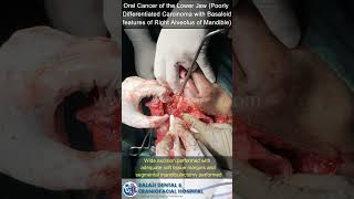 Oral Cancer of Lower Jaw (Poorly Differentiated Carcinoma with Basaloid features of Lower Jaw)