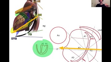 MITRAL VALVE SCALLOPS FOR DUMMIES