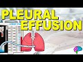 Pleural Effusion and Related Disorders Quiz