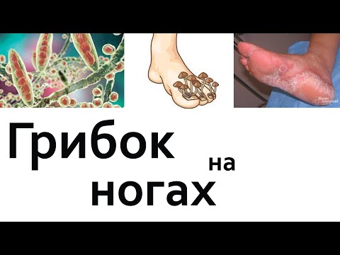 Главная причина грибка ногтей и лучшее средство от грибка