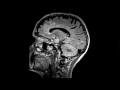 More than just a picture: Quantitative brain image analysis could positively impact MS patient care