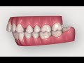 Invisalign | ejemplo de evolución dientes en vista lateral