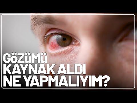 Gözden Kaynak Nasıl Çıkar