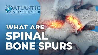 What Are Spinal Bone Spurs | Spinal Osteophytes