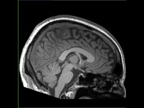 Anatomical (T1w) Preprocessing Tutorial