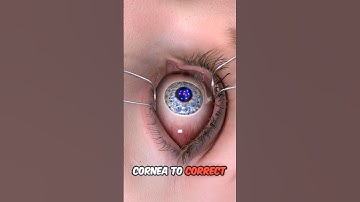 LASIK Eye Surgery #shorts #lasik