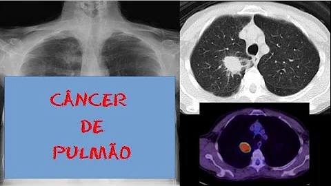 Como identificar tumor na tomografia?