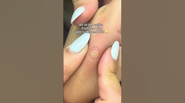 Watch what happens when a Mom uses the Bug Bite Thing Suction Tool on her child