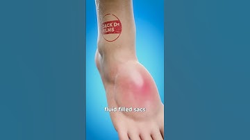 Should You Pop Giant Blisters? 💦