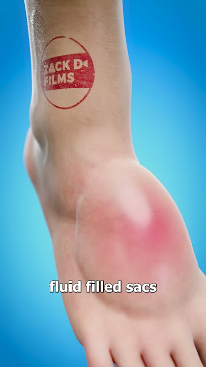 Should You Pop Giant Blisters? 💦