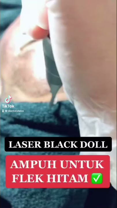 LASER BLACK DOLL PENGHILANG FLEK HITAM | doctor deka